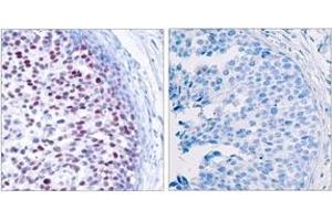 Immunohistochemistry analysis of paraffin-embedded human breast carcinoma, using c-Jun (Phospho-Thr239) Antibody. (C-JUN 抗体  (pThr239))