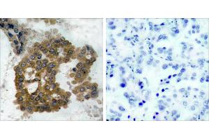 P-Peptide - +Immunohistochemical analysis of paraffin-embedded human lung carcinoma tissue using Akt2 (phospho- Ser474) antibody. (AKT2 抗体  (pSer474))