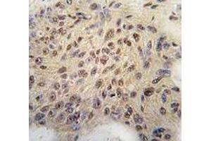 IHC analysis of FFPE human breast carcinoma tissue stained with Cyclin D1 antibody (Cyclin D1 抗体  (AA 68-97))