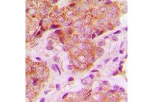 Immunohistochemical analysis of MRPS22 staining in human breast cancer formalin fixed paraffin embedded tissue section. (MRPS22 抗体)