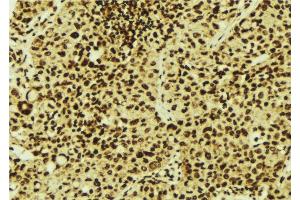 ABIN6277089 at 1/100 staining Human breast cancer tissue by IHC-P. (PIN1 抗体  (N-Term))