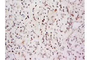 Formalin-fixed and paraffin embedded Glioma cell tumor labeled with Anti-SARA Polyclonal Antibody, Unconjugated  at 1:500 followed by conjugation to the secondary antibody and DAB staining. (ZFYVE9 抗体  (AA 71-170))
