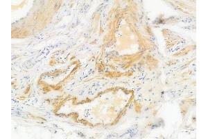 ABIN6256659 and ABIN6267529 at 1/100 staining human testicular cancer by IHC-P. (JNK 抗体  (pTyr185))