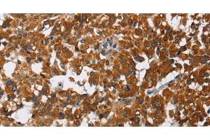 Immunohistochemistry of paraffin-embedded Human thyroid cancer using CAT Polyclonal Antibody at dilution of 1:40 (Catalase 抗体)
