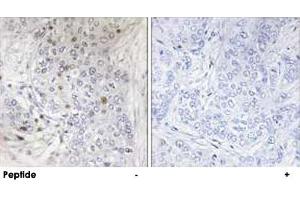 Immunohistochemistry analysis of paraffin-embedded human breast carcinoma tissue, using MAFF polyclonal antibody . (MafF 抗体)