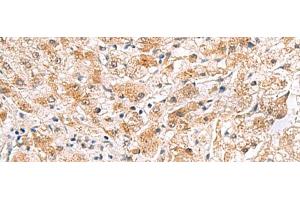 Immunohistochemistry of paraffin-embedded Human liver cancer tissue using PDCL2 Polyclonal Antibody at dilution of 1:65(x200) (PDCL2 抗体)