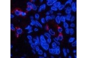 Immunofluorescence analysis of Human lung cancer tissue using LTF Monoclonal Antibody at dilution of 1:200. (Lactoferrin 抗体)