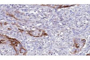 ABIN6273628 at 1/100 staining Human urothelial cancer tissue by IHC-P. (FGFBP1 抗体  (C-Term))