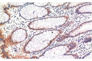 Immunohistochemistry of paraffin-embedded Human colon carcinoma tissue with Phospho-MLKL (Ser358) Monoclonal Antibody at dilution of 1:200 (MLKL 抗体  (pSer358))