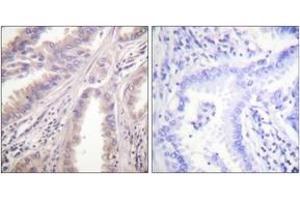 Immunohistochemistry analysis of paraffin-embedded human lung carcinoma tissue, using KIF11/Eg5 (Ab-927) Antibody. (KIF11 抗体  (AA 892-941))