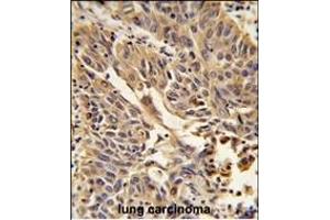 Formalin-fixed and paraffin-embedded human lung carcinoma reacted with JUP Antibody (C-term), which was peroxidase-conjugated to the secondary antibody, followed by DAB staining. (JUP 抗体  (C-Term))