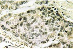 Immunohistochemistry (IHC) analyzes of p-SNAI 1 antibody in paraffin-embedded human lung carcinoma tissue. (SNAIL 抗体  (pSer246))