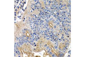 Immunohistochemistry of paraffin-embedded human colon carcinoma using PTGIR antibody.