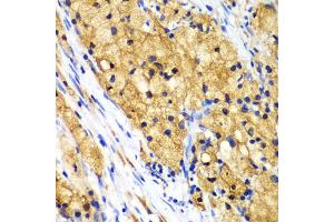 Immunohistochemistry of paraffin-embedded human lung cancer using CAPG Antibody. (CAPG 抗体)