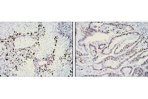 Immunohistochemical analysis of paraffin-embedded lung cancer (left) and rectal cancer (right) using KI67 mouse mAb with DAB staining. (Ki-67 抗体)