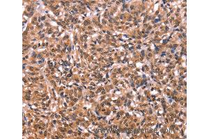 Immunohistochemistry of Human liver cancer using ESRRB Polyclonal Antibody at dilution of 1:40 (ESRRB 抗体)