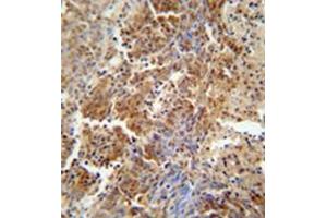 Formalin fixed and paraffin embedded human lung carcinoma reacted with ERCC8 Antibody  followed by peroxidase conjugation of the secondary antibody and DAB staining. (ERCC8 抗体  (Middle Region))