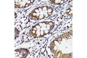 Immunohistochemistry of paraffin-embedded human colon using COX2/PTGS2 Rabbit pAb (ABIN6130125, ABIN6146415, ABIN6146417 and ABIN6216190) at dilution of 1:50 (40x lens). (PTGS2 抗体  (AA 375-604))