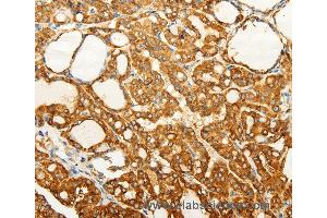 Immunohistochemistry of Human gastric cancer using FZD6 Polyclonal Antibody at dilution of 1:60 (FZD6 抗体)