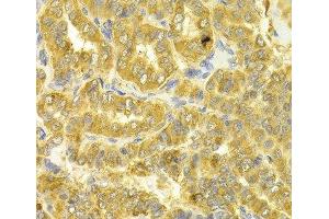 Immunohistochemistry of paraffin-embedded Human thyroid cancer using DLD Polyclonal Antibody at dilution of 1:100 (40x lens). (DLD 抗体)