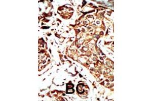 Formalin-fixed and paraffin-embedded human cancer tissue reacted with BRD3 polyclonal antibody  , which was peroxidase-conjugated to the secondary antibody, followed by AEC staining. (BRD3 抗体  (C-Term))