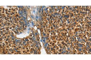 Immunohistochemistry of paraffin-embedded Human liver cancer tissue using ADCY4 Polyclonal Antibody at dilution 1:45 (ADCY4 抗体)