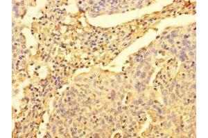 Immunohistochemistry of paraffin-embedded human cervical cancer using ABIN7175093 at dilution of 1:100 (UPRT 抗体  (AA 1-309))