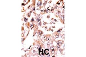 Formalin-fixed and paraffin-embedded human cancer tissue reacted with the primary antibody, which was peroxidase-conjugated to the secondary antibody, followed by AEC staining. (Dual Specificity Phosphatase 3 (DUSP3) (AA 1-30), (N-Term) 抗体)