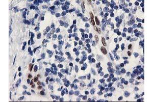 Immunohistochemical staining of paraffin-embedded Adenocarcinoma of Human breast tissue using anti-ELK3 mouse monoclonal antibody. (ELK3 抗体)