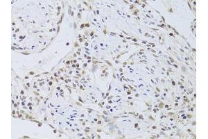 Immunohistochemistry of paraffin-embedded human gastric cancer using FKBP4 Antibody (ABIN5973289) at dilution of 1/100 (40x lens). (FKBP4 抗体)