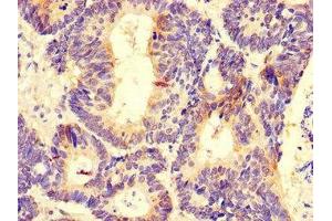 Immunohistochemistry of paraffin-embedded human colon cancer using ABIN7164372 at dilution of 1:100 (DDX6 抗体  (AA 1-149))