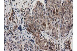 Immunohistochemical staining of paraffin-embedded Adenocarcinoma of Human breast tissue using anti-MAPRE2 mouse monoclonal antibody. (MAPRE2 抗体)
