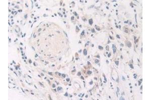 Detection of GLa in Human Stomach cancer Tissue using Polyclonal Antibody to Galactosidase Alpha (GLa)