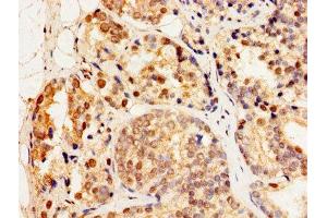 Immunohistochemistry of paraffin-embedded human prostate cancer using ABIN7154893 at dilution of 1:100 (HSF2 抗体  (AA 79-173))