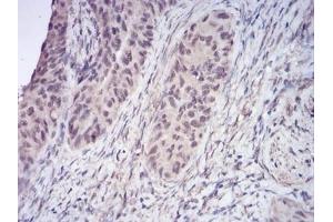 Immunohistochemical analysis of paraffin-embedded human cervical cancer tissues using HDAC2 mouse mAb with DAB staining. (HDAC2 抗体  (AA 217-327))