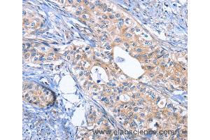 Immunohistochemistry of Human cervical cancer using INHBC Polyclonal Antibody at dilution of 1:50 (INHBC 抗体)
