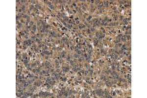 Immunohistochemistry of Human liver cancer using KCNN4 Polyclonal Antibody at dilution of 1:40 (KCNN4 抗体)