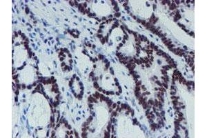 Immunohistochemical staining of paraffin-embedded Adenocarcinoma of Human colon tissue using anti-METT10D mouse monoclonal antibody. (METTL16 抗体)