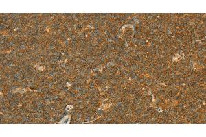 Immunohistochemistry of paraffin-embedded Human lymphoma using APOL2 Polyclonal Antibody at dilution of 1:80