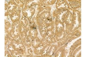 ABIN6262615 and ABIN6269090 at 1/100 staining human renal cell carcinoma by IHC-P.