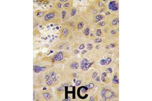 Formalin-fixed and paraffin-embedded human hepatocellular carcinoma reacted with PFKFB1 polyclonal antibody  , which was peroxidase-conjugated to the secondary antibody, followed by DAB staining. (PFKFB1 抗体  (N-Term))