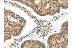The image on the left is immunohistochemistry of paraffin-embedded Human colon cancer tissue using ABIN7192661(SSTR5 Antibody) at dilution 1/30, on the right is treated with synthetic peptide. (SSTR5 抗体)