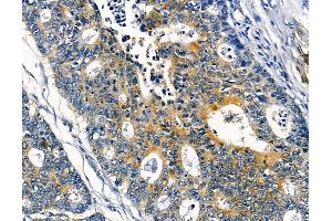 ABIN6256861 and ABIN6273953 at 1/100 staining human prostate cancer and adjacent non-tumor tissue by IHC-P. (NPY4R 抗体  (N-Term))