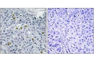 Immunohistochemistry analysis of paraffin-embedded human breast carcinoma, using TOP2A (Phospho-Ser1106) Antibody. (Topoisomerase II alpha 抗体  (pSer1106))