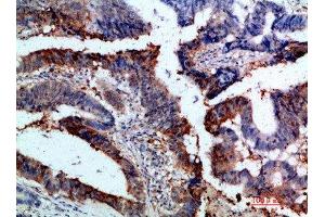 Immunohistochemical analysis of paraffin-embedded human-colon-cancer, antibody was diluted at 1:200 (Integrin alpha 1 抗体  (AA 920-980))