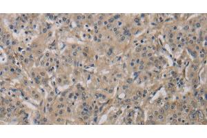 Immunohistochemistry of paraffin-embedded Human gastric cancer tissue using DCN Polyclonal Antibody at dilution 1:30 (Decorin 抗体)
