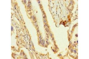 Immunohistochemistry of paraffin-embedded human pancreatic cancer using ABIN7162135 at dilution of 1:100