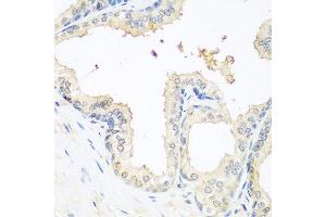 Immunohistochemistry of paraffin-embedded human prostate using MMP14 antibody at dilution of 1:100 (40x lens).
