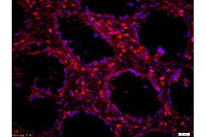 Formalin-fixed and paraffin embedded human colon carcinoma labeled with Anti-LSP1 Polyclonal Antibody, Unconjugated (ABIN755632) at 1:200 followed by conjugation to the secondary antibody Goat Anti-Rabbit IgG,PE conjugated used at 1:200 dilution for 40 minutes at 37°C and DAPI staining (LSP1 抗体  (AA 241-339))