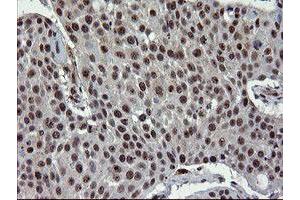 Immunohistochemical staining of paraffin-embedded Carcinoma of Human lung tissue using anti-UBE2E3 mouse monoclonal antibody. (UBE2E3 抗体)